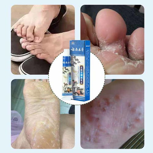 康凈衛生用品 專業止癢噴劑廠家在線咨詢，您的個人衛生守護者